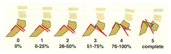 A set of 6 drawings of bones in the low back showing different degrees of spine slippage.