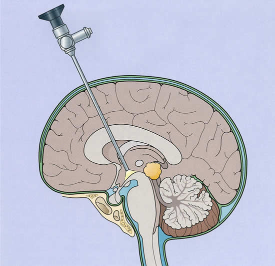The approach made by an endoscope. Reprinted from 'Principles of Neurosurgery,' 2nd edition, Edited by Setti S. Rengachary, Richard G. Ellenbogen, Copyright (2005), with permission from Elsevier