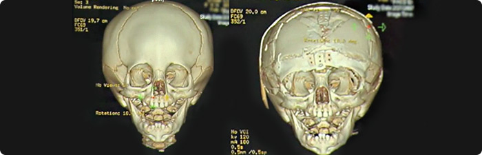 xray images of skulls