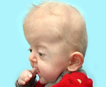 Apert Syndrome Baby