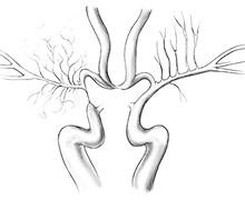 Carotid artery – moyamoya