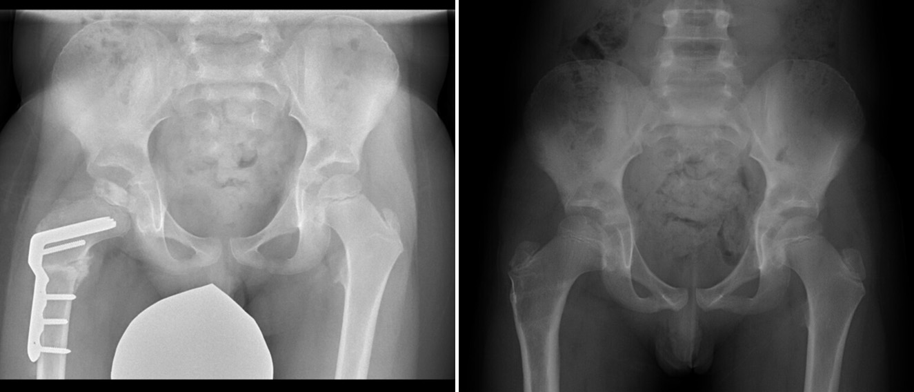 2 x-rays, 1 showing a hip with an implant in the upper thighbone and 1 showing the same bone without the implant after it healed 