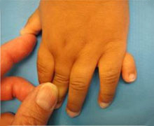 Polydactyly 3