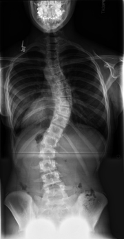 X-ray of a child from the head to the pelvis showing an S-shaped spinal curve