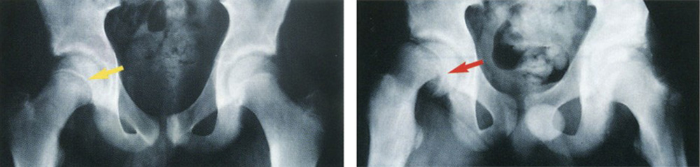 2 x-rays, 1 showing a typical hip joint and 1 showing the top of a thighbone that has slipped out of place