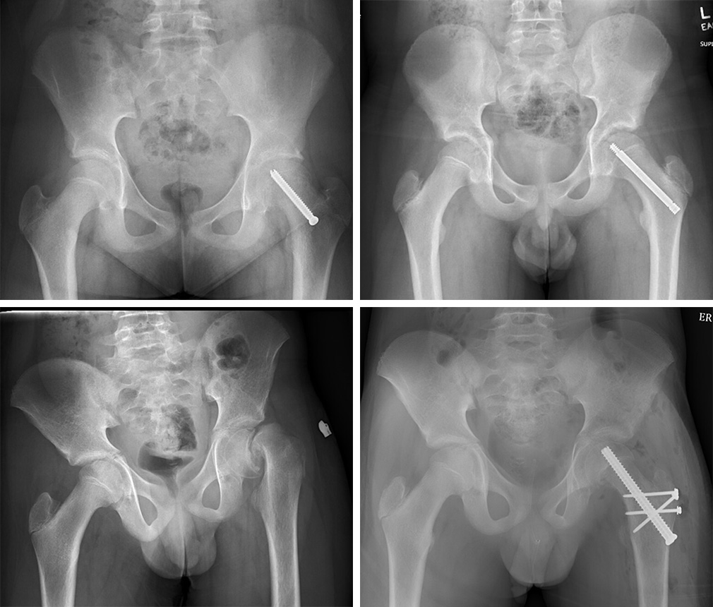 Four X-rays: X-ray showing a screw that goes through the upper thighbone into the femoral head; X-ray showing a screw that goes through the upper thighbone into the femoral head; 2 x-rays, 1 showing a severe care of the femoral head slipping off the upper thighbone and 1 showing the bone realigned and help in place with 4 screws