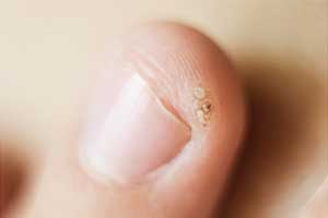 Close-up of a finger with a wart