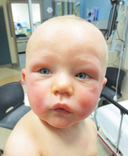 Infant experiencing anaphylaxis