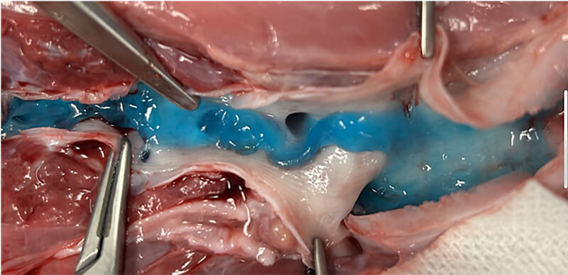 Macroscopic image showing impacted mucus (blue gel) obstructing the bronchial airways.