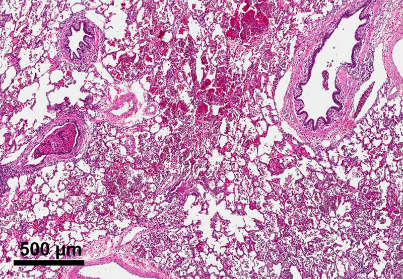 Lung histopathology in a surfactant-deficient subject that did not receive surfactant (left).
