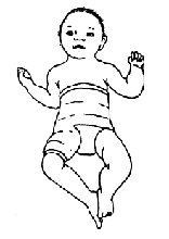 Drawing of a baby in a spica cast for dysplasia of only their right hip.