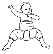Drawing of a baby in a spica cast for dysplasia of both hips.