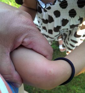 A large mosquito bite on a childs hand.