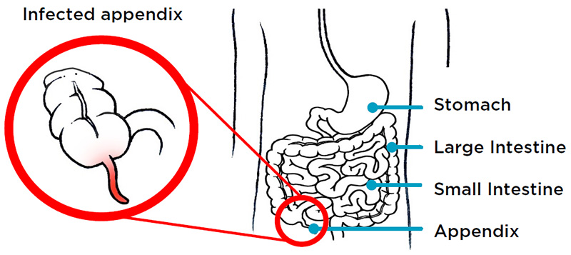 Illustration of an appendix