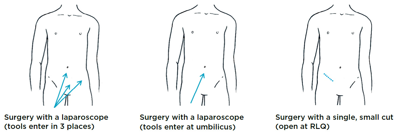 Illustration displaying 3 different types of appendectomies
