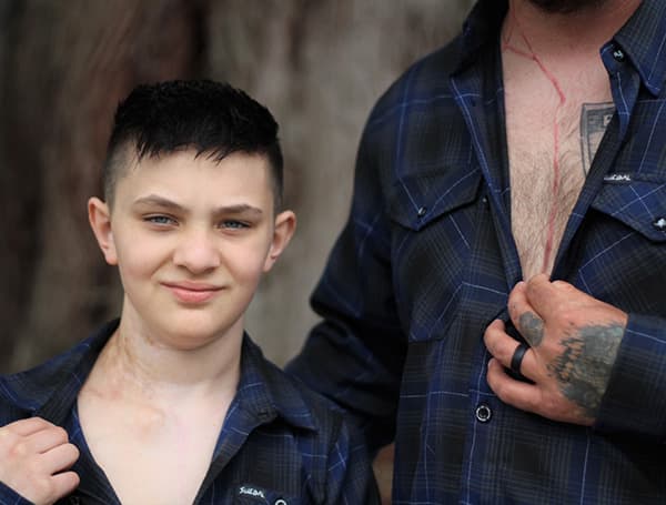 A few weeks after Ryder Gordon’s first surgery at Seattle Children’s, Thomas Gordon went to the tattoo shop and got an exact replica of his son’s scar on his neck and chest.