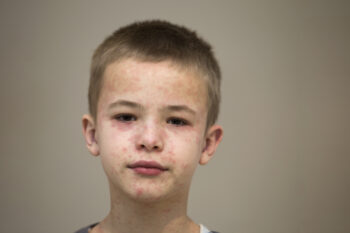 boy with measles all over his face