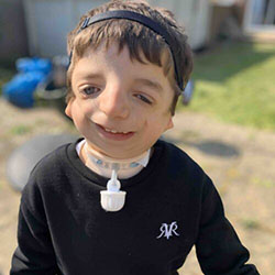 A boy with Treacher Collins syndrome