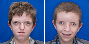Dino Velagic Apert syndrome Apert syndrome