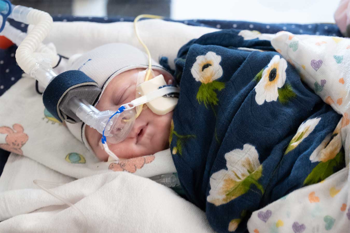 CDH patient in Seattle Children’s NICU