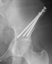 Xray of hip with screws