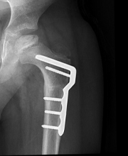 X-ray showing metal plates and screws to hold the upper-leg bone in place while it heals