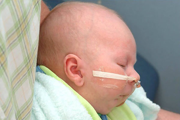 A baby with a breathing tube