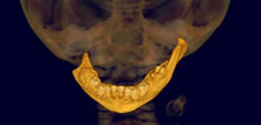 Jaw of a child born with bilateral hemifacial microsomia