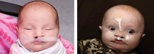 Left: A baby whose cleft lip is taped. Right: A baby with lip taping and a nasal elevator for cleft lip and palate.