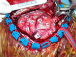 Brain mapping during surgery