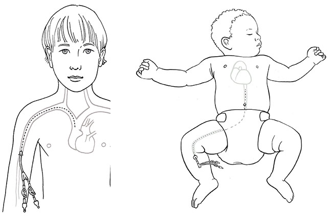 Illustration of a PICC line