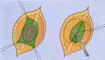 Closing the defect in spina bifida. Reprinted from 'Principles of Neurosurgery,' 2nd edition, edited by Setti S. Rengachary, Richard G. Ellenbogen. Copyright 2005, with permission from Elsevier Closing the defect in spina bifida. Reprinted from 'Principles of Neurosurgery,' 2nd edition, edited by Setti S. Rengachary, Richard G. Ellenbogen. Copyright 2005, with permission from Elsevier