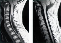 MRI of Chiari of syrinx before and after decompression.