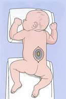 The child is in position for repair of his spina bifida. Reprinted from 'Principles of Neurosurgery,' 2nd edition, edited by Setti S. Rengachary, Richard G. Ellenbogen. Copyright 2005, with permission from Elsevier The child is in position for repair of his spina bifida. Reprinted from 'Principles of Neurosurgery,' 2nd edition, edited by Setti S. Rengachary, Richard G. Ellenbogen. Copyright 2005, with permission from Elsevier