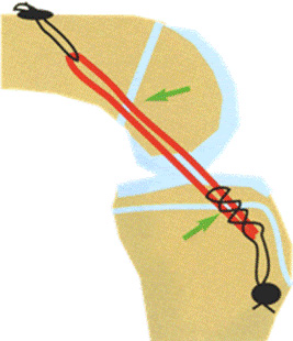 Illustration of a new ACL placed in the knee and attached to the lower thigh bone and upper shinbone