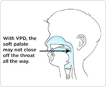 Speech with VPD: An open soft palate lets air flow through the nose and mouth (shown in blue).