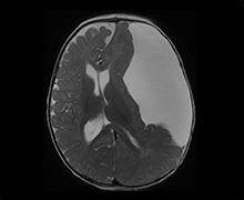 Arachnoid Cyst Size Chart