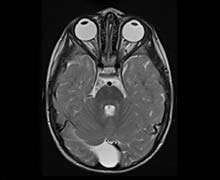 Arachnoid Cyst Size Chart