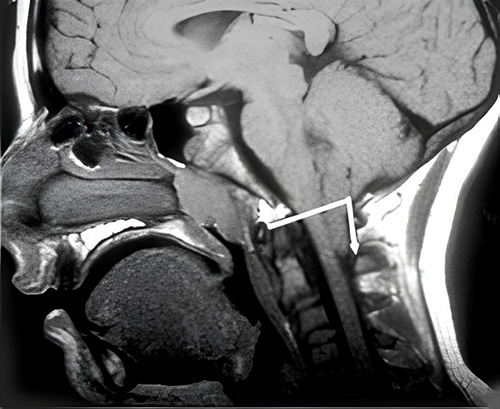 MRI showing Chiari malformation
