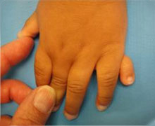 Congenital Hand Disorders polydactyly