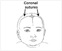 Coronal sutures