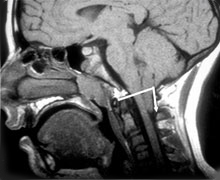Chiari malformation Chiari malformation