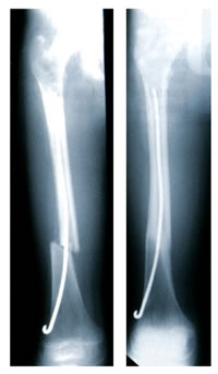 Flexible rod stabilization. Courtesy of 'Fundamentals of Pediatric Orthopedics,' © 2003 Lippincott Williams & Wilkins