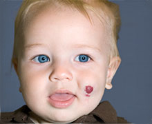 Hemangioma Hemangioma