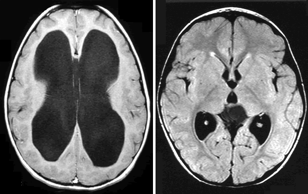 Hydrocephalus normal, non-normal MRI scans