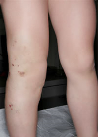 Klippel-Trénaunay Syndrome Klippel-Trénaunay Syndrome