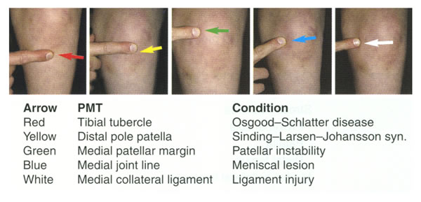 Kneecap tenderness. Courtesy of 'Fundamentals of Pediatric Orthopedics,' © 2003 Lippincott Williams & Wilkins