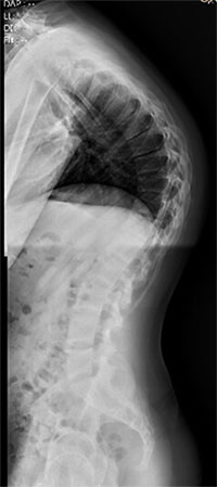X-ray of a child from the shoulders to the pelvis showing a forward spinal curve that is larger than usual