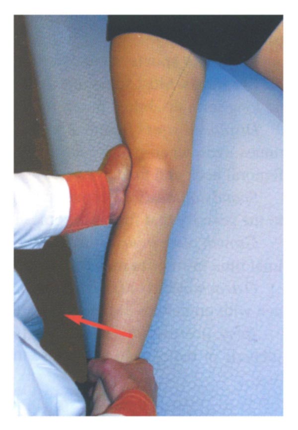 MCL Injuries - Seattle Children's