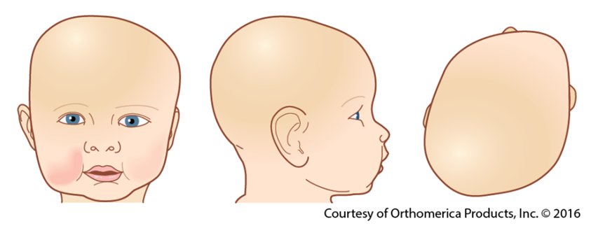 Young child's head with a flat spot
